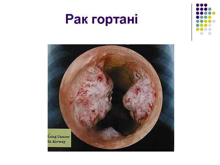 Рак гортані 