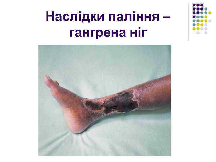 Наслідки паління – гангрена ніг 