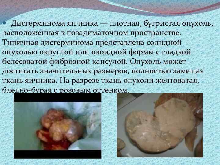  Дисгерминома яичника — плотная, бугристая опухоль, расположенная в позадиматочном пространстве. Типичная дисгерминома представлена