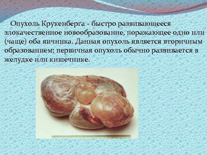 Опухоль Крукенберга быстро развивающееся злокачественное новообразование, поражающее одно или (чаще) оба яичника. Данная опухоль