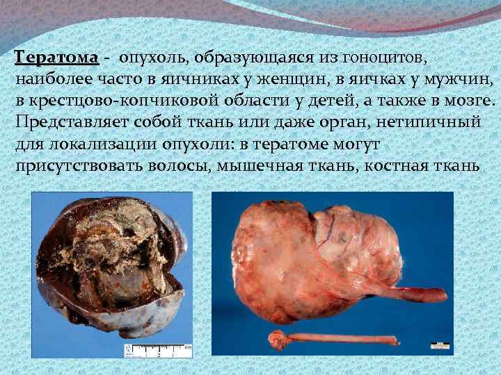 Тератома опухоль, образующаяся из гоноцитов, наиболее часто в яичниках у женщин, в яичках у