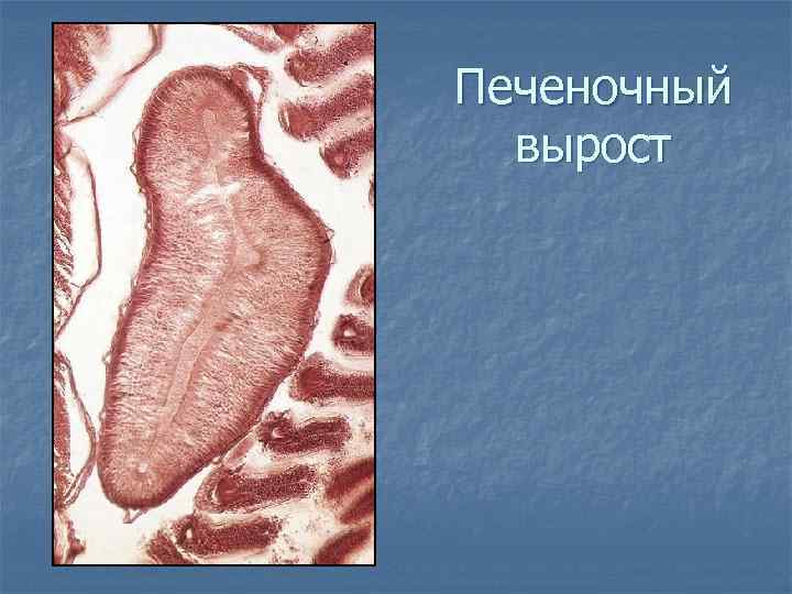 Печеночный вырост 