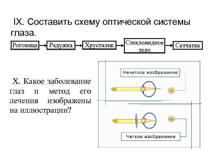  IX. Составить схему оптической системы глаза. Роговица Радужка Хрусталик X. Какое заболевание глаз