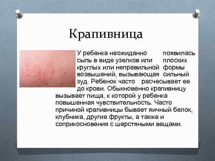 Крапивница У ребенка неожиданно появилась сыпь в виде узелков или плоских круглых или неправильной