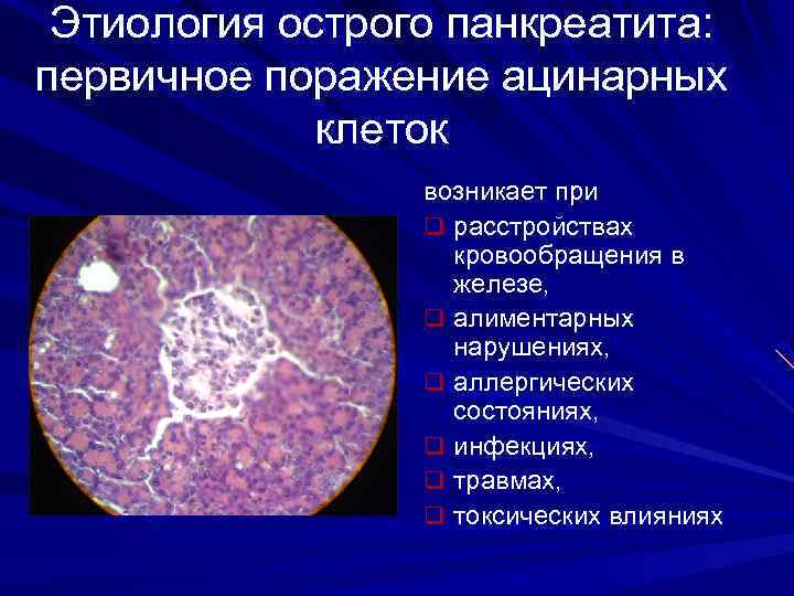 Этиология острого панкреатита: первичное поражение ацинарных клеток возникает при q расстройствах кровообращения в железе,