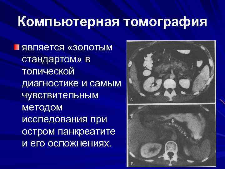 Компьютерная томография является «золотым стандартом» в топической диагностике и самым чувствительным методом исследования при