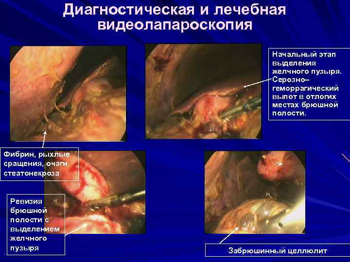 Диагностическая и лечебная видеолапароскопия Начальный этап выделения желчного пузыря. Серозно– геморрагический выпот в отлогих