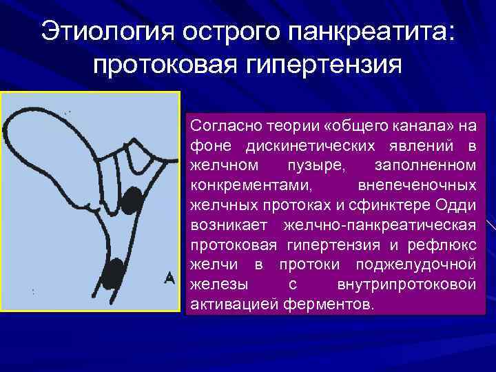 Этиология острого панкреатита: протоковая гипертензия Согласно теории «общего канала» на фоне дискинетических явлений в