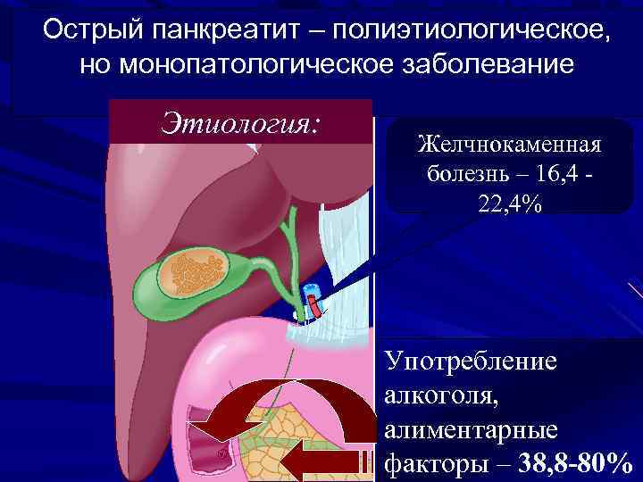 Острый панкреатит – полиэтиологическое, но монопатологическое заболевание Этиология: Желчнокаменная болезнь – 16, 4 22,