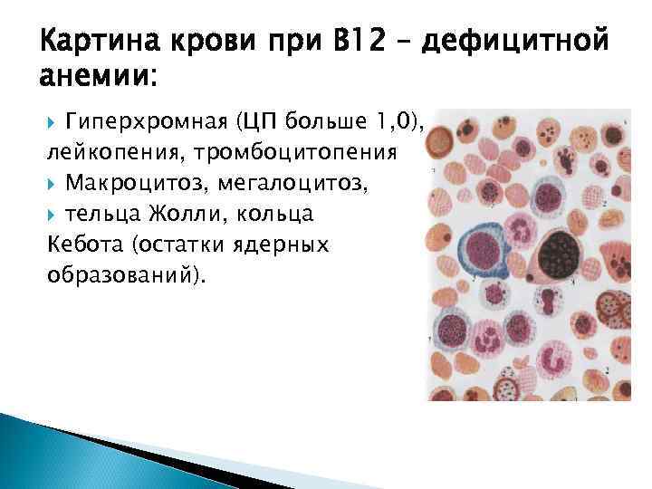 Картина крови при В 12 – дефицитной анемии: Гиперхромная (ЦП больше 1, 0), лейкопения,