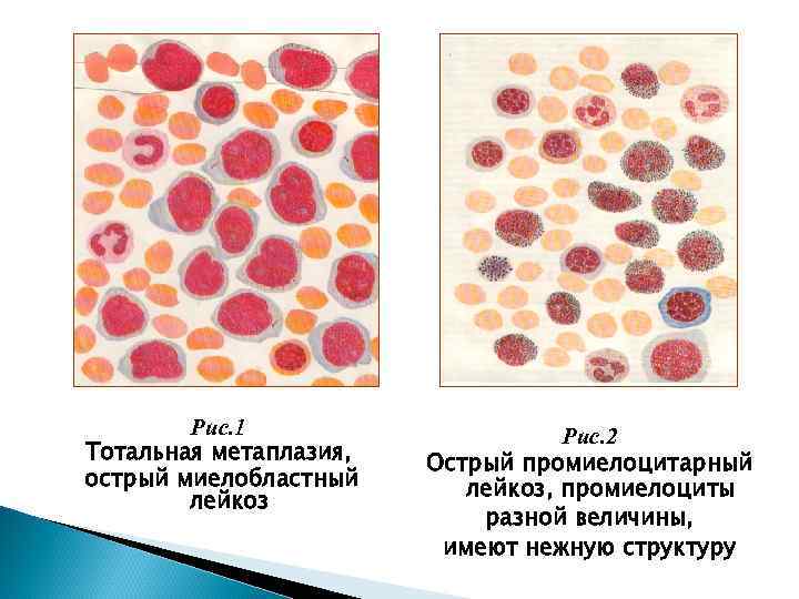 Рис. 1 Тотальная метаплазия, острый миелобластный лейкоз Рис. 2 Острый промиелоцитарный лейкоз, промиелоциты разной