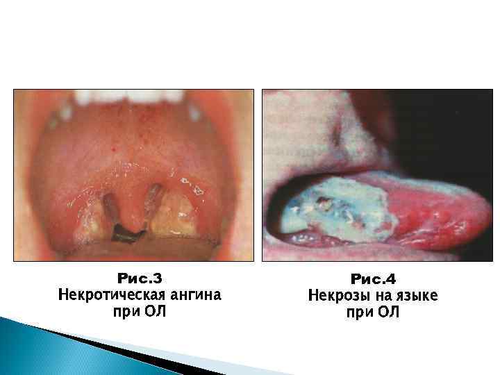 Рис. 3 Некротическая ангина при ОЛ Рис. 4 Некрозы на языке при ОЛ 