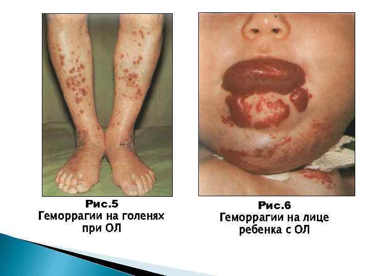 Рис. 5 Геморрагии на голенях при ОЛ Рис. 6 Геморрагии на лице ребенка с