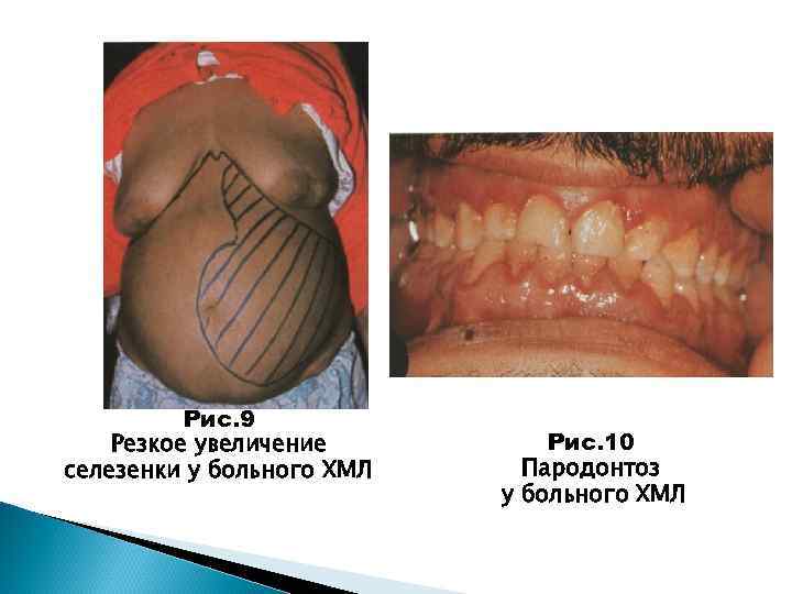 Рис. 9 Резкое увеличение селезенки у больного ХМЛ Рис. 10 Пародонтоз у больного ХМЛ