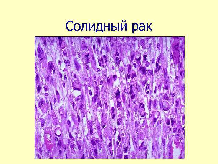 Солидное строение опухоли это. Трабекулярное строение опухоли это. Трабекулярные структуры опухоли.