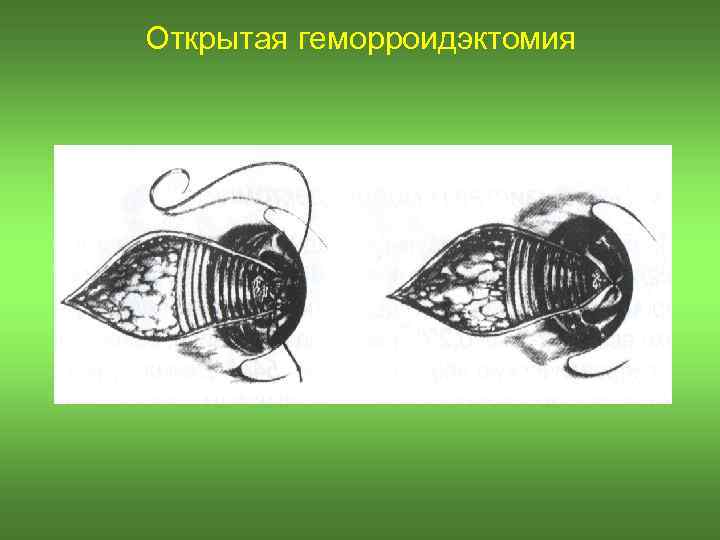 Открытая геморроидэктомия 