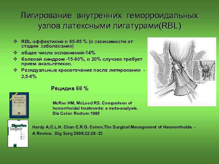 Лигирование внутренних геморроидальных узлов латексными лигатурами(RBL) v RBL-эффективно в 65 -85 % (в зависимости