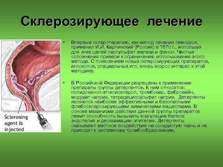 Склерозирующее лечение • Впервые склеротерапию, как метод лечения геморроя, применил И. И. Карпинский (Россия)