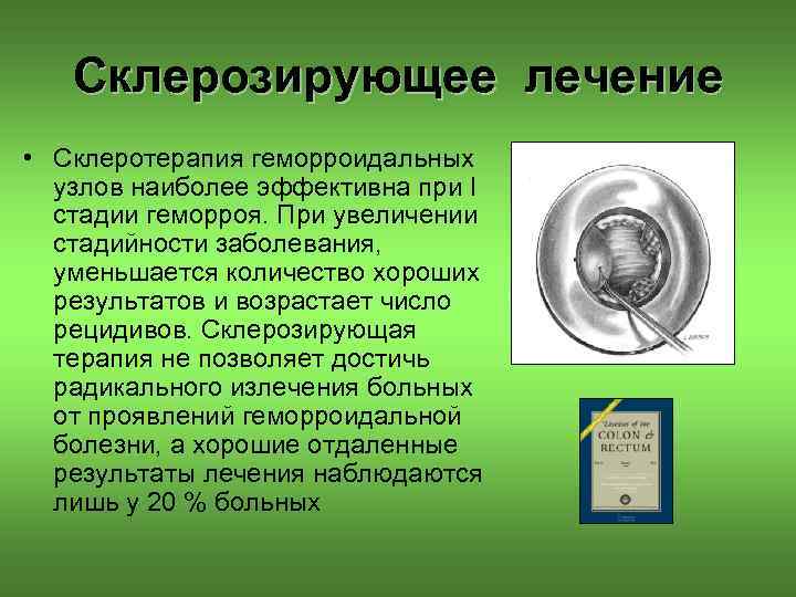 Склерозирующее лечение • Склеротерапия геморроидальных узлов наиболее эффективна при I стадии геморроя. При увеличении