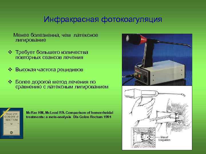 Инфракрасная фотокоагуляция Менее болезненна, чем латексное лигирование v Требует большего количества повторных сеансов лечения