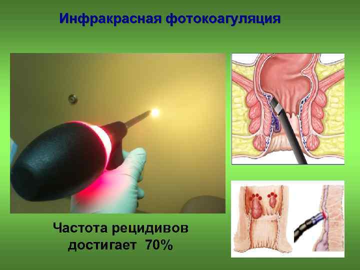 Инфракрасная фотокоагуляция Частота рецидивов достигает 70% 