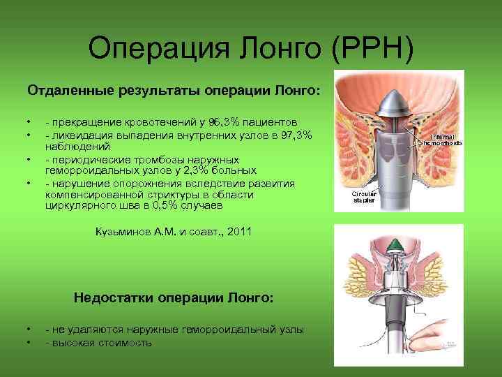 Операция Лонго (PPH) Отдаленные результаты операции Лонго: • • прекращение кровотечений у 96, 3%