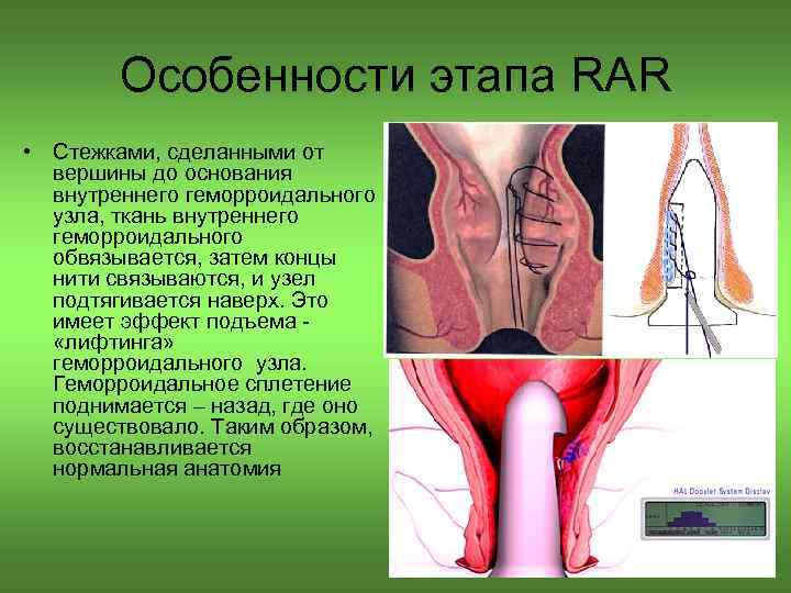 Особенности этапа RAR • Стежками, сделанными от вершины до основания внутреннего геморроидального узла, ткань