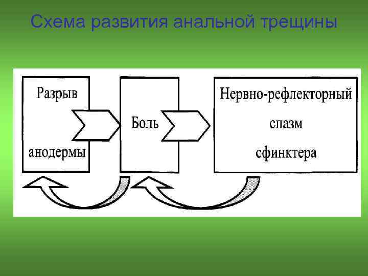 Схема развития анальной трещины 