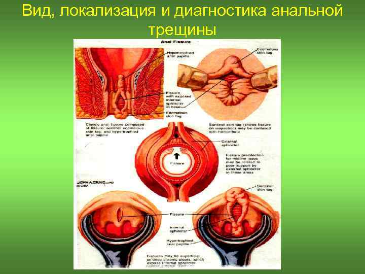 Вид, локализация и диагностика анальной трещины 