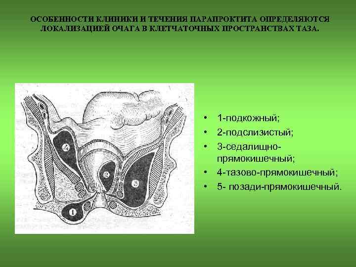 ОСОБЕННОСТИ КЛИНИКИ И ТЕЧЕНИЯ ПАРАПРОКТИТА ОПРЕДЕЛЯЮТСЯ ЛОКАЛИЗАЦИЕЙ ОЧАГА В КЛЕТЧАТОЧНЫХ ПРОСТРАНСТВАХ ТАЗА. • 1