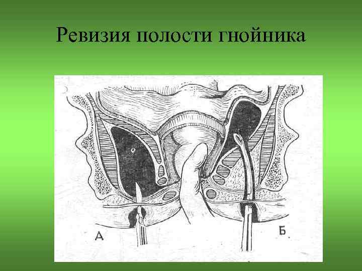 Ревизия полости гнойника 