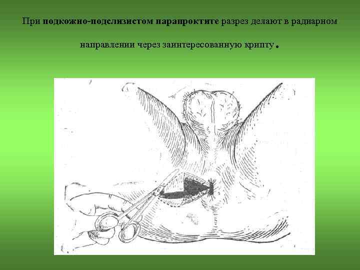 При подкожно-подслизистом парапроктите разрез делают в радиарном направлении через заинтересованную крипту . 