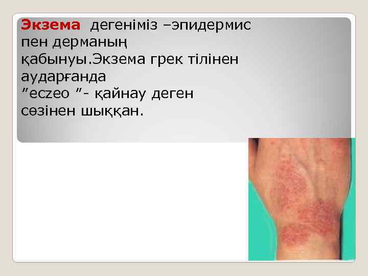 Экзема дегеніміз –эпидермис пен дерманың қабынуы. Экзема грек тілінен аударғанда ″eczeo ″- қайнау деген