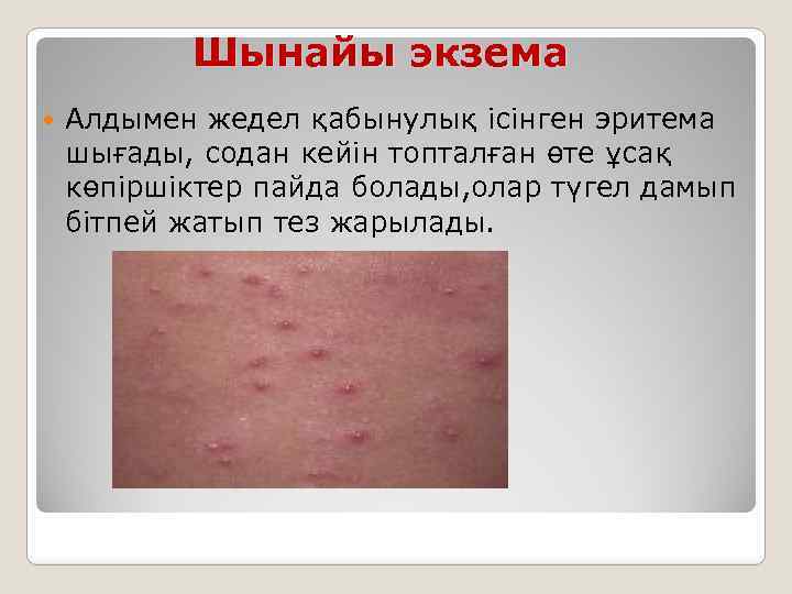 Шынайы экзема Алдымен жедел қабынулық ісінген эритема шығады, содан кейін топталған өте ұсақ көпіршіктер