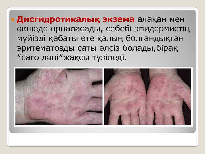  Дисгидротикалық экзема алақан мен өкшеде орналасады, себебі эпидермистің мүйізді қабаты өте қалың болғандықтан