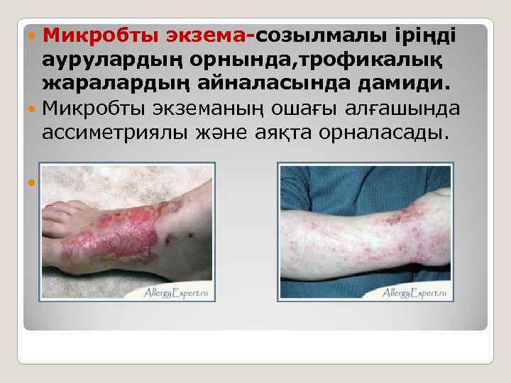 Микробты экзема-созылмалы іріңді аурулардың орнында, трофикалық жаралардың айналасында дамиди. Микробты экземаның ошағы алғашында ассиметриялы