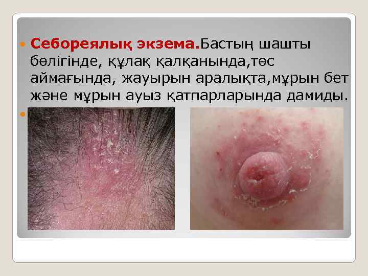  Себореялық экзема. Бастың шашты бөлігінде, құлақ қалқанында, төс аймағында, жауырын аралықта, мұрын бет