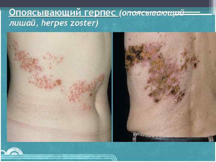 Опоясывающий герпес (опоясывающий лишай, herpes zoster) 