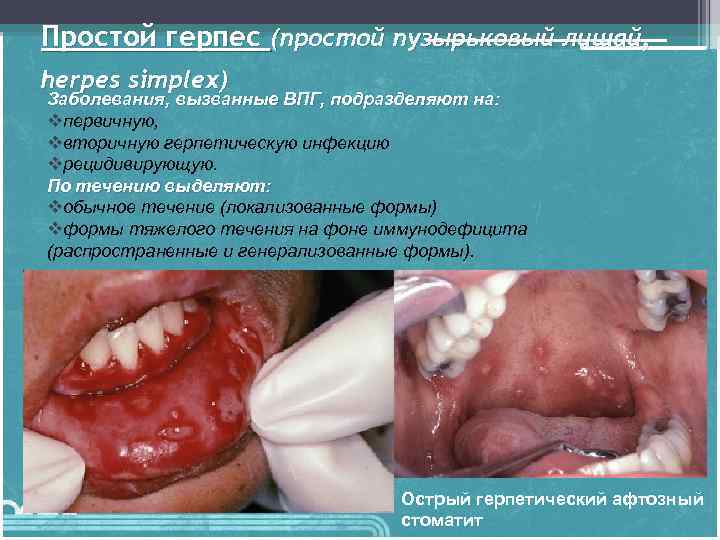 Простой герпес (простой пузырьковый лишай, herpes simplex) Заболевания, вызванные ВПГ, подразделяют на: vпервичную, vвторичную