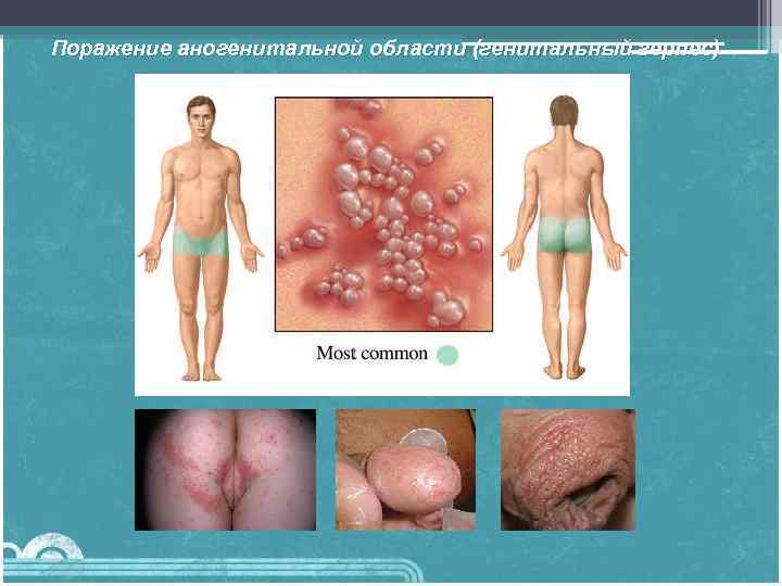 Поражение аногенитальной области (генитальный герпес) 