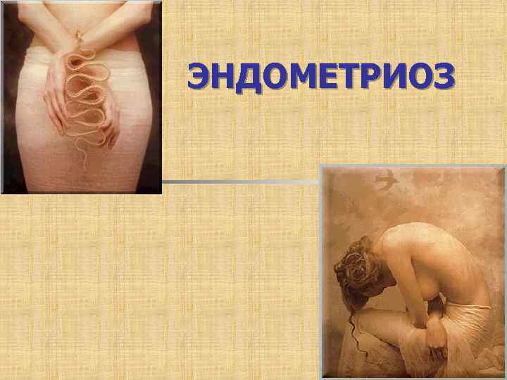 ЭНДОМЕТРИОЗ 