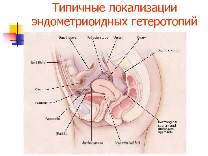 Типичные локализации эндометриоидных гетеротопий 