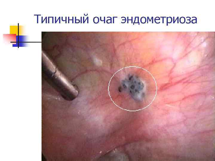 Типичный очаг эндометриоза 