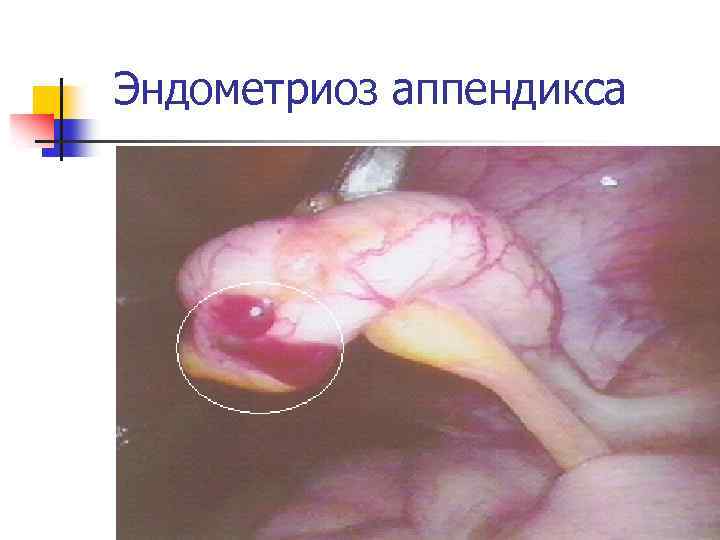 Эндометриоз аппендикса 