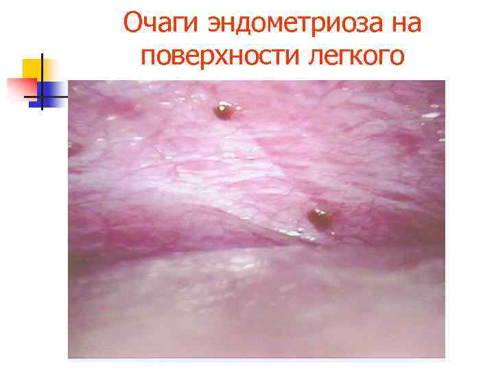 Очаги эндометриоза на поверхности легкого 