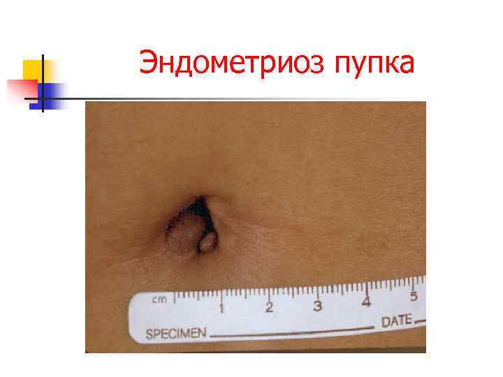 Эндометриоз пупка 