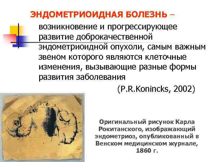 ЭНДОМЕТРИОИДНАЯ БОЛЕЗНЬ – возникновение и прогрессирующее развитие доброкачественной эндометриоидной опухоли, самым важным звеном которого