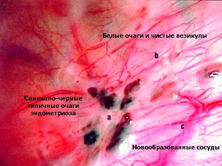 Белые очаги и чистые везикулы Синюшно-черные типичные очаги эндометриоза Новообразованные сосуды 