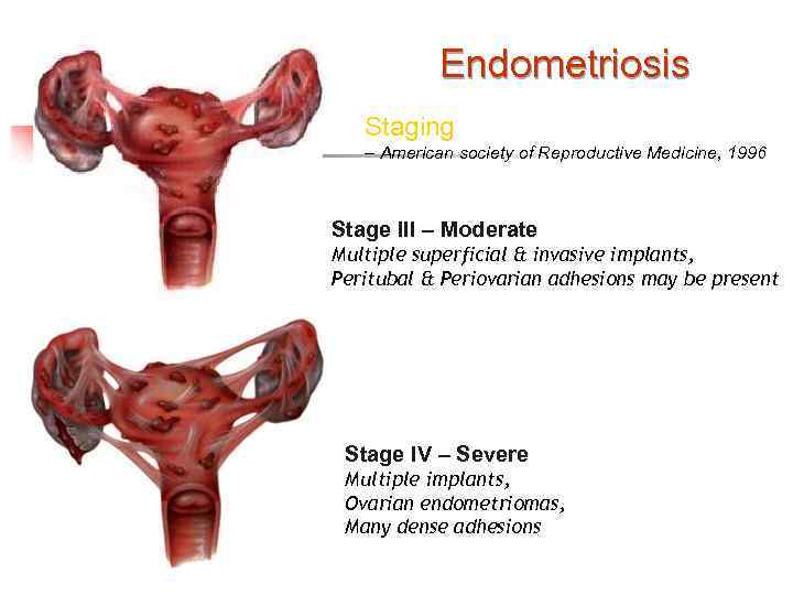 Endometriosis Staging – American society of Reproductive Medicine, 1996 Stage III – Moderate Multiple