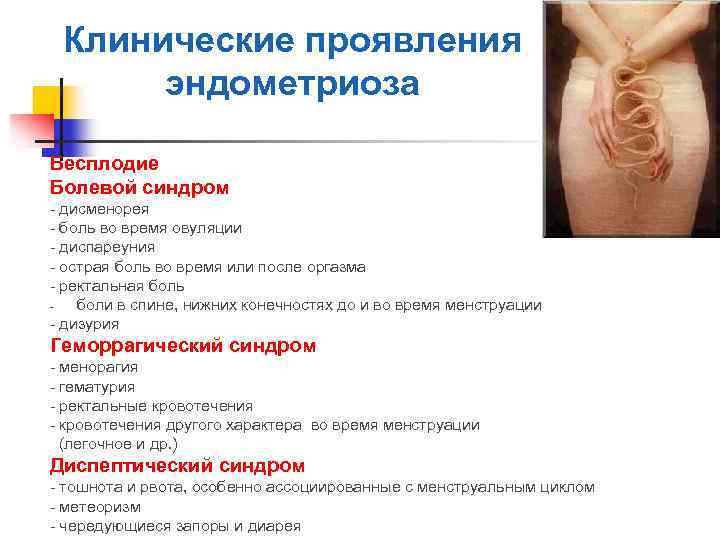 Клинические проявления эндометриоза Бесплодие Болевой синдром - дисменорея - боль во время овуляции -